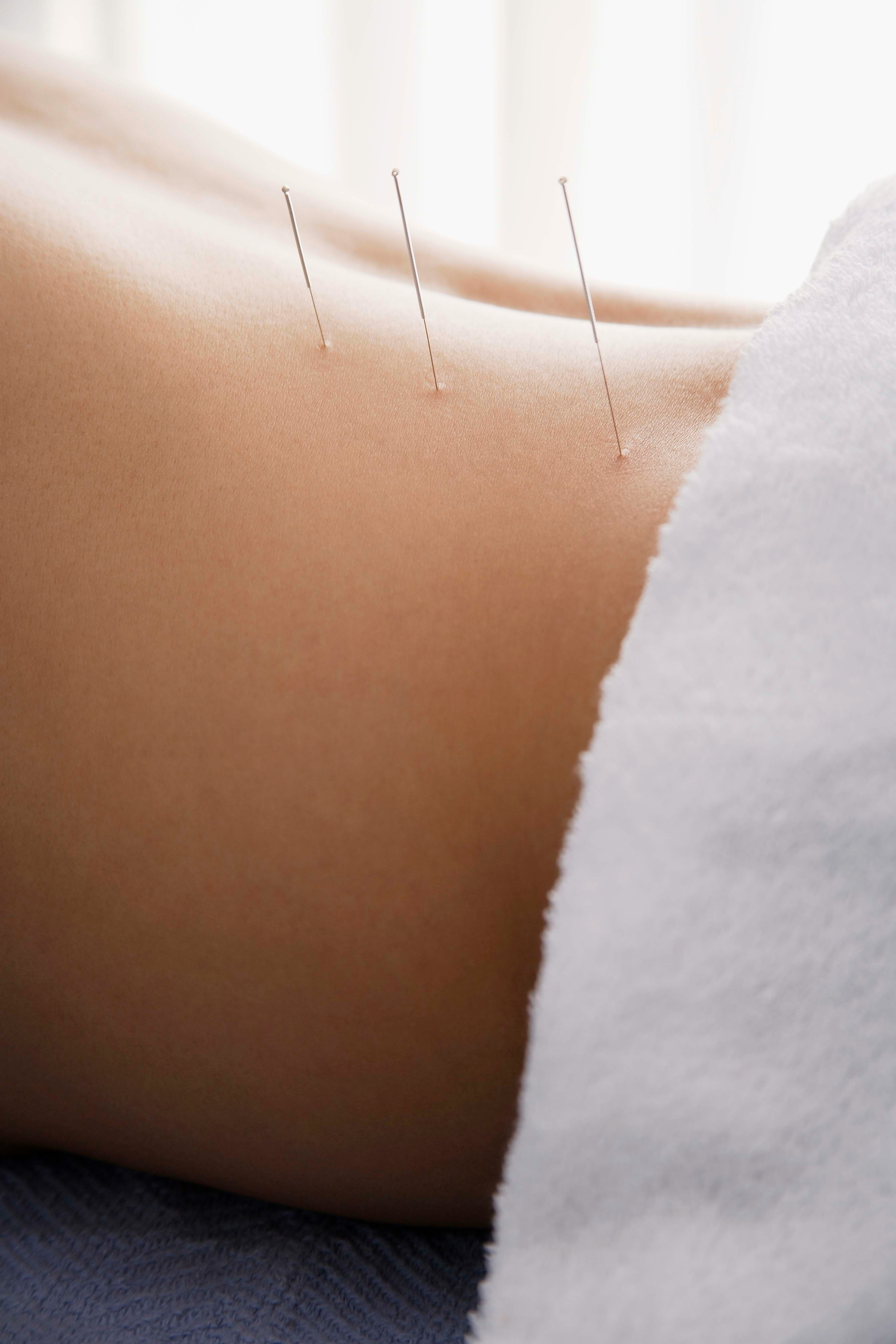 Acupuncture needles during treatment